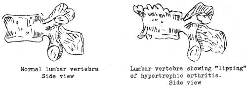 Normal lumbar vertebra Side view, Lumbar vertebra showing 'lipping' of hypertrophic arthritis. Side view